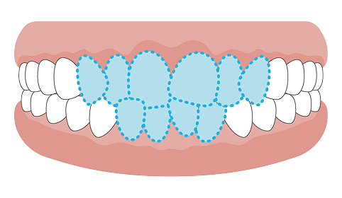 がたがた（叢生）の歯並びのイメージ