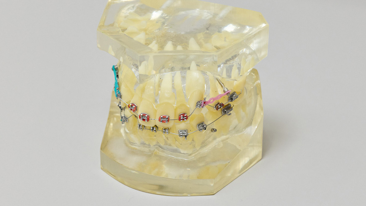 歯科矯正用アンカースクリューを使用した矯正治療