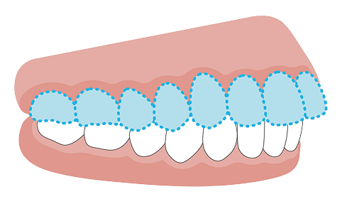かみ合わせが深い（過蓋咬合）の歯並びのイメージ