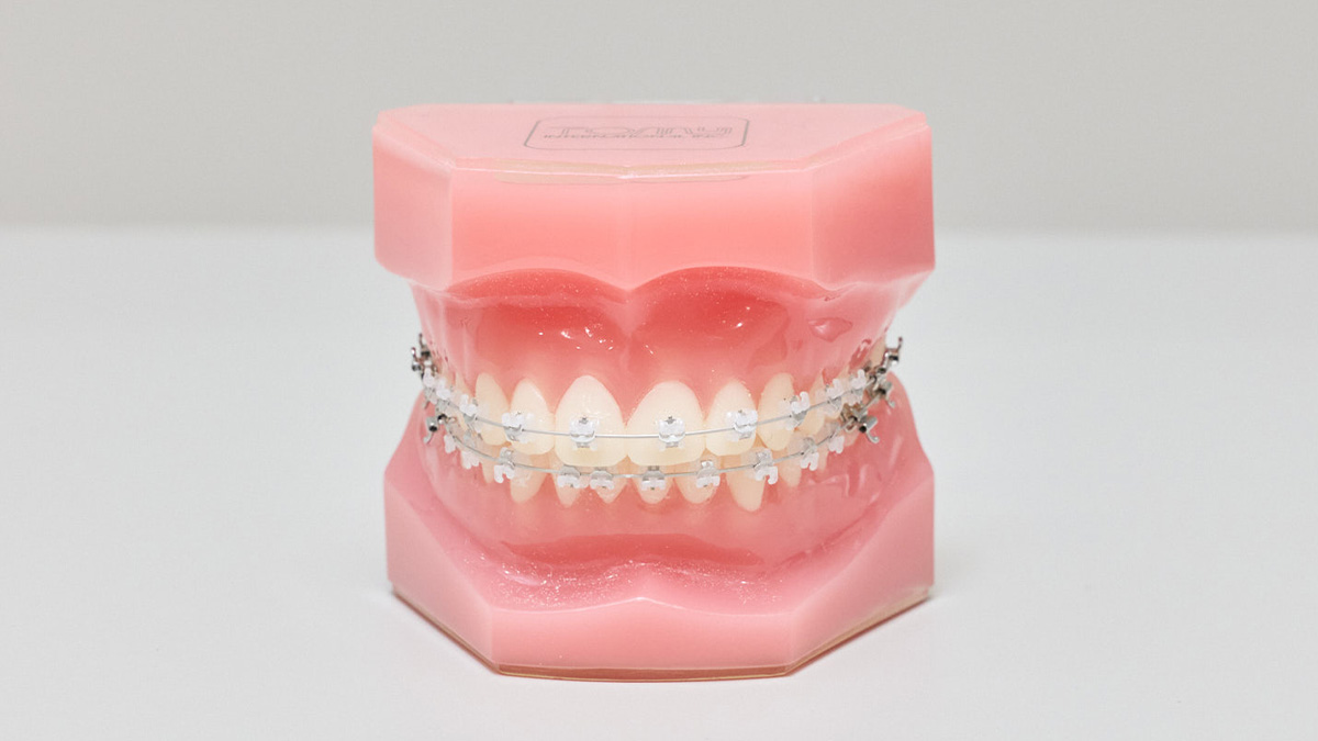 マルチブラケット装置による過蓋咬合の矯正治療