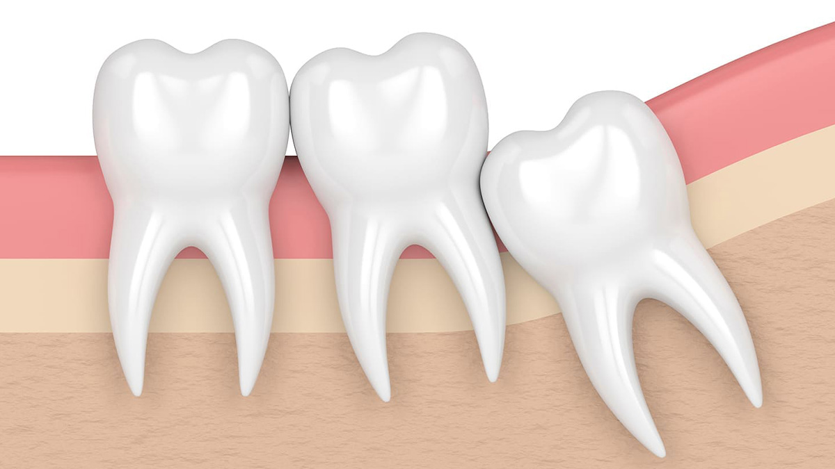 埋伏歯の開窓・牽引治療のイメージ