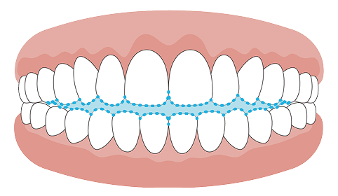 開咬（かいこう）の歯並びのイメージ