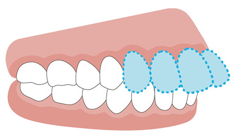 出っ歯（上顎前突）の歯並びのイメージ