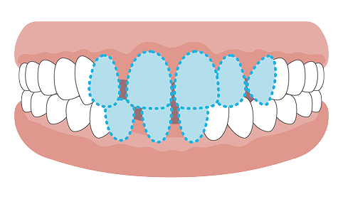 すきっ歯（空隙歯列）の歯並びのイメージ