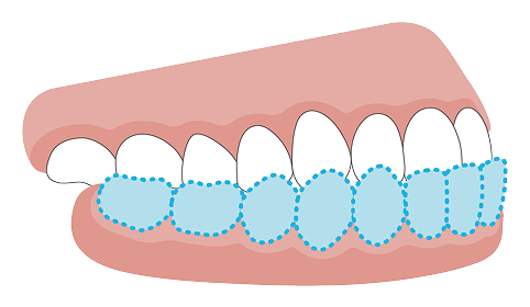 受け口（反対咬合）の歯並びのイメージ