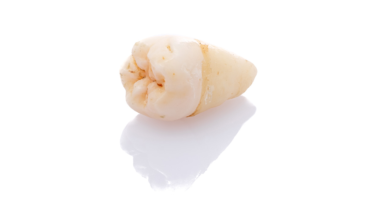 抜歯・非抜歯の判断に用いる横顔の分析イメージ