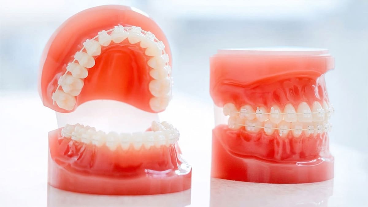 表側矯正（マルチブラケット装置）のイメージ