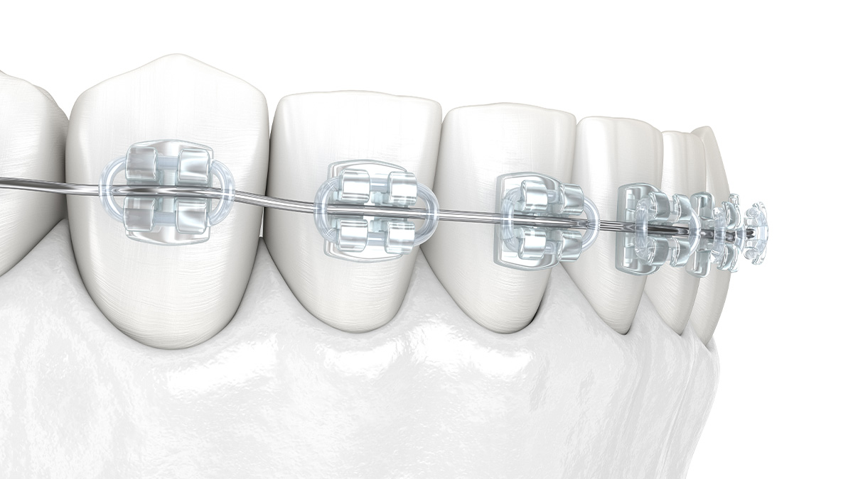 透明なプラスチックブラケットの装着例