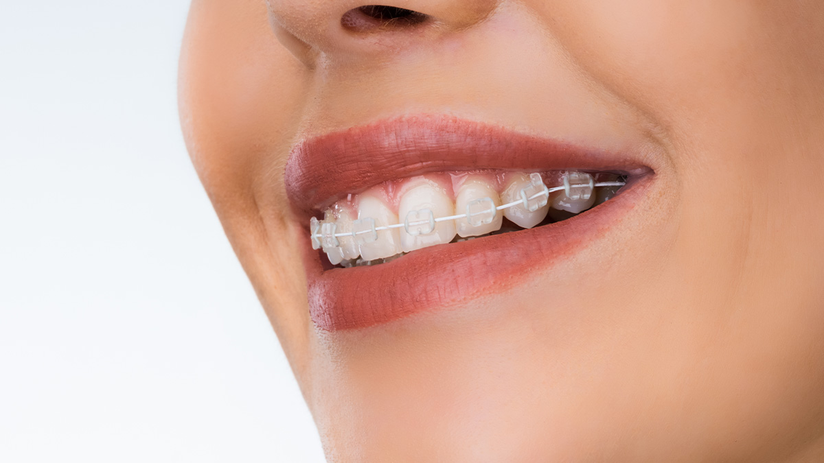 ホワイトワイヤーを使用した矯正装置