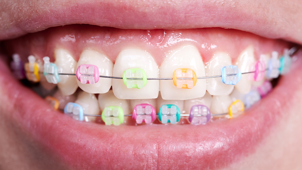 カラーモジュールを使った矯正装置