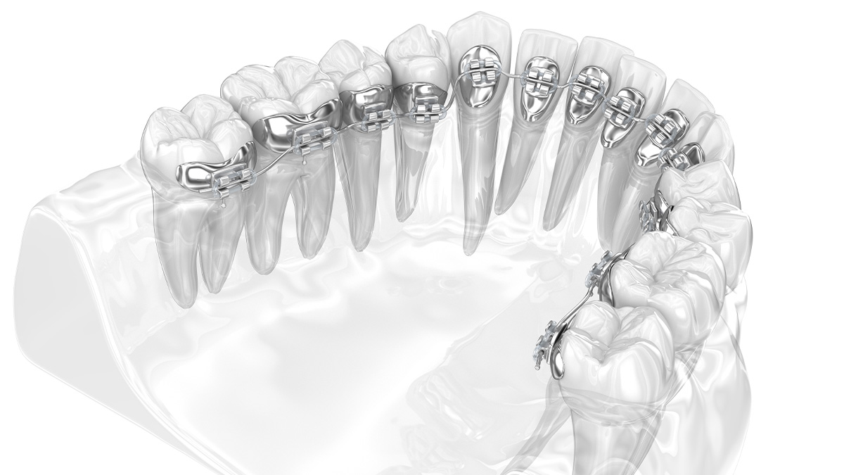 舌側矯正（裏側矯正）の装置イメージ