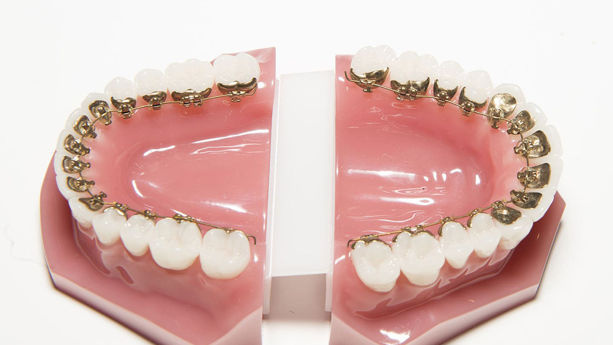 フルリンガル矯正の装着例