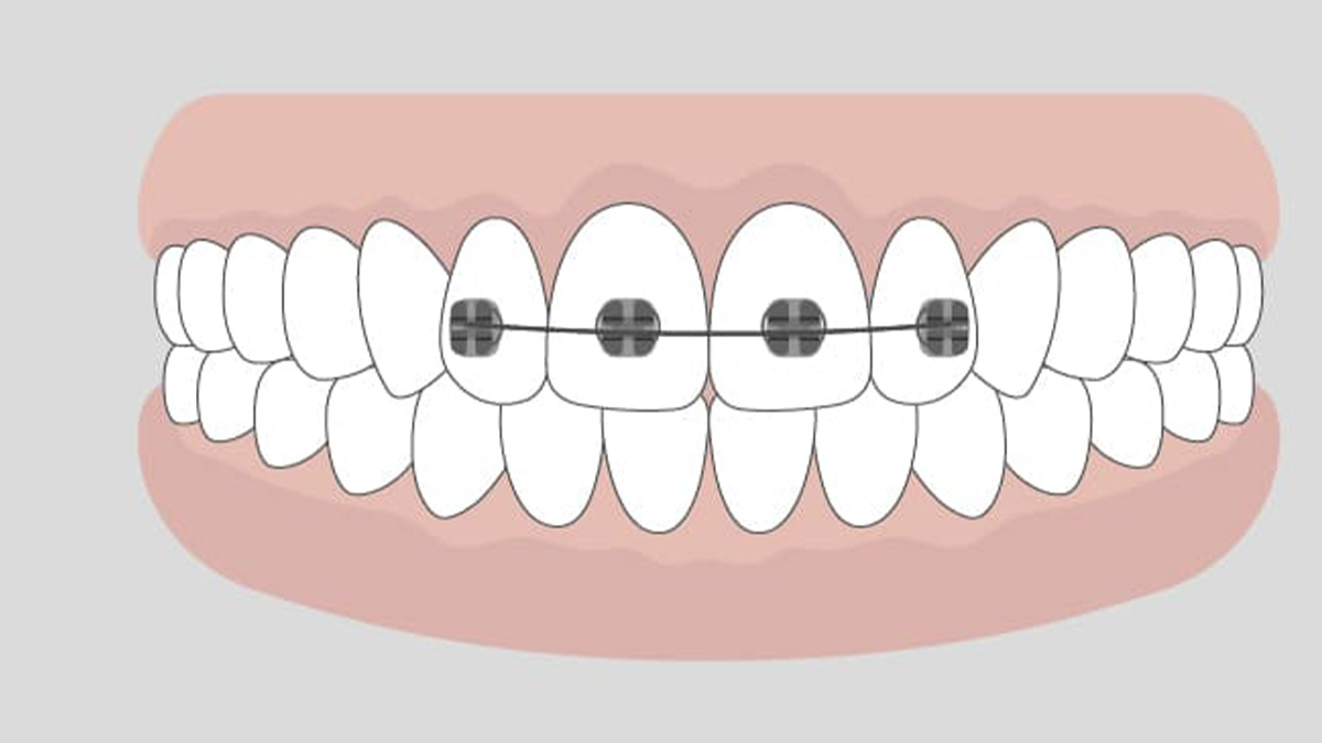 部分矯正で前歯を整えるイメージ