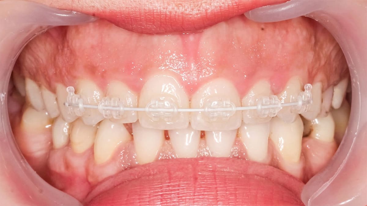 ワイヤーによる部分矯正