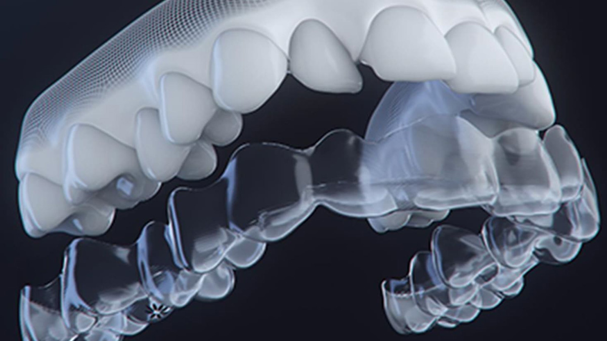 マウスピースによる部分矯正